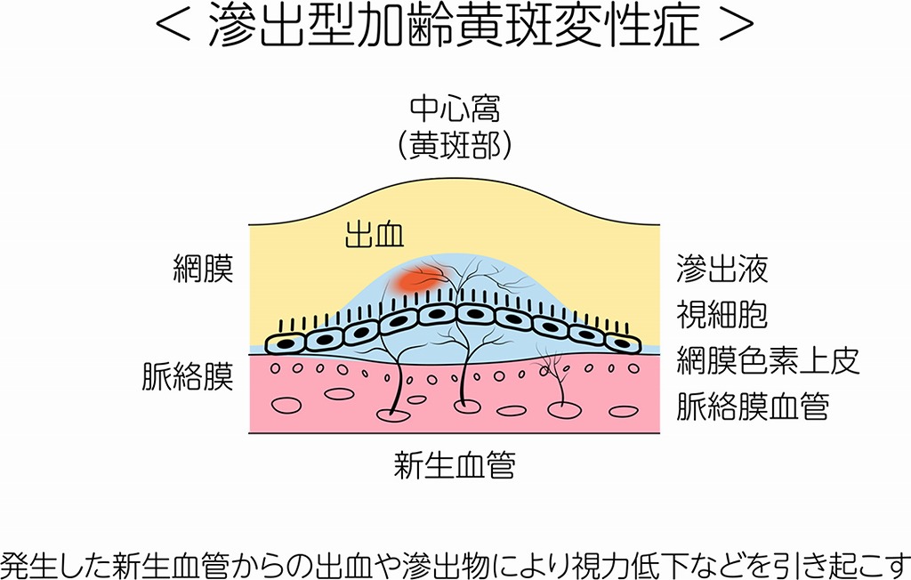 滲出型加齢黄斑変性症