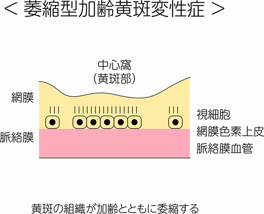 萎縮型加齢黄斑変性症