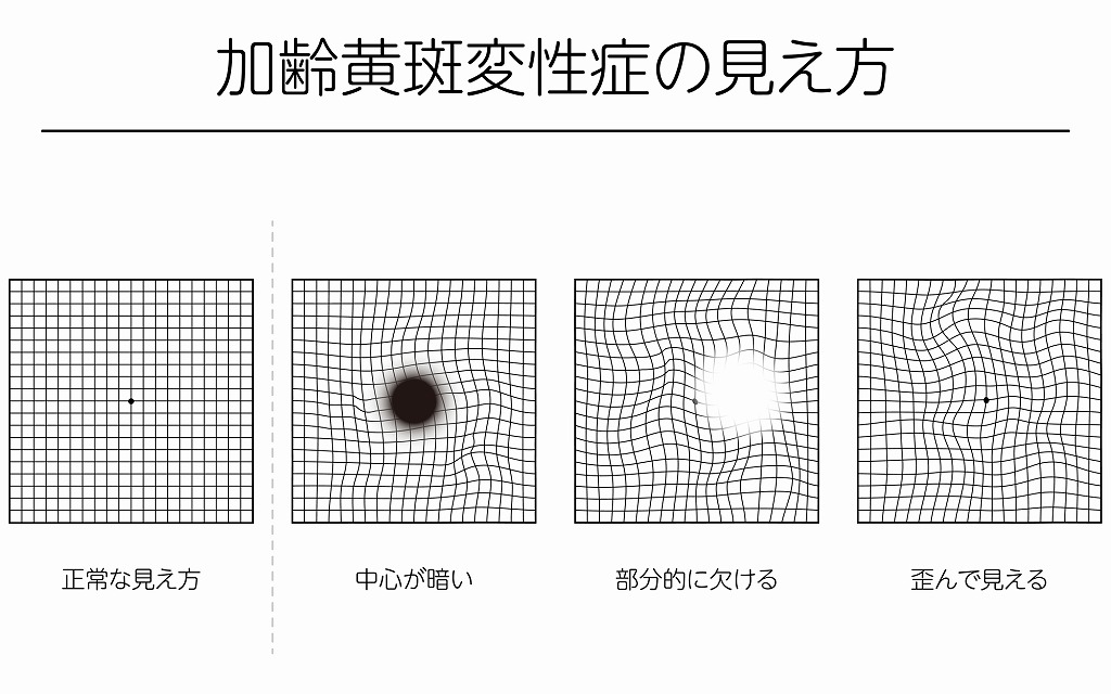 加齢黄斑変性の見え方