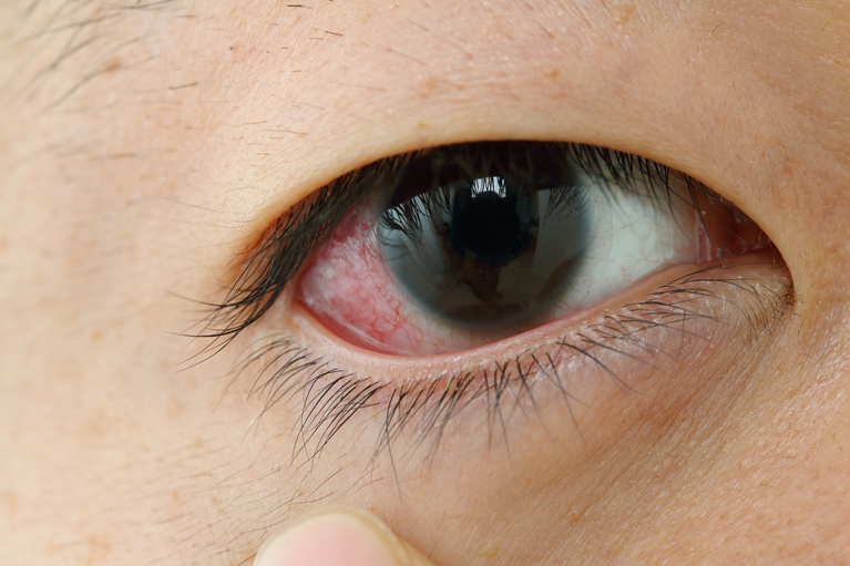 目の充血が起こるメカニズム