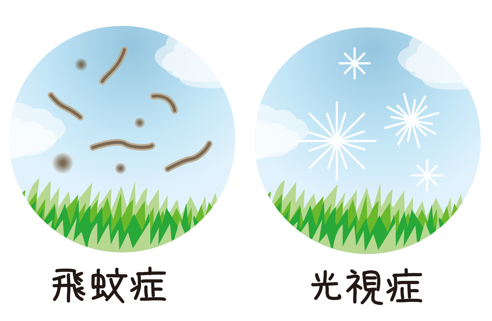 網膜剥離の症状・見え方