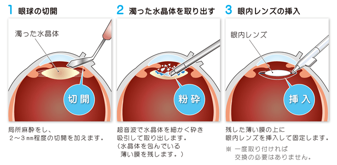 白内障手術の方法