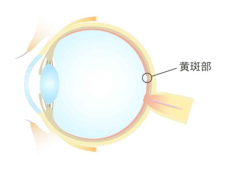 黄斑円孔